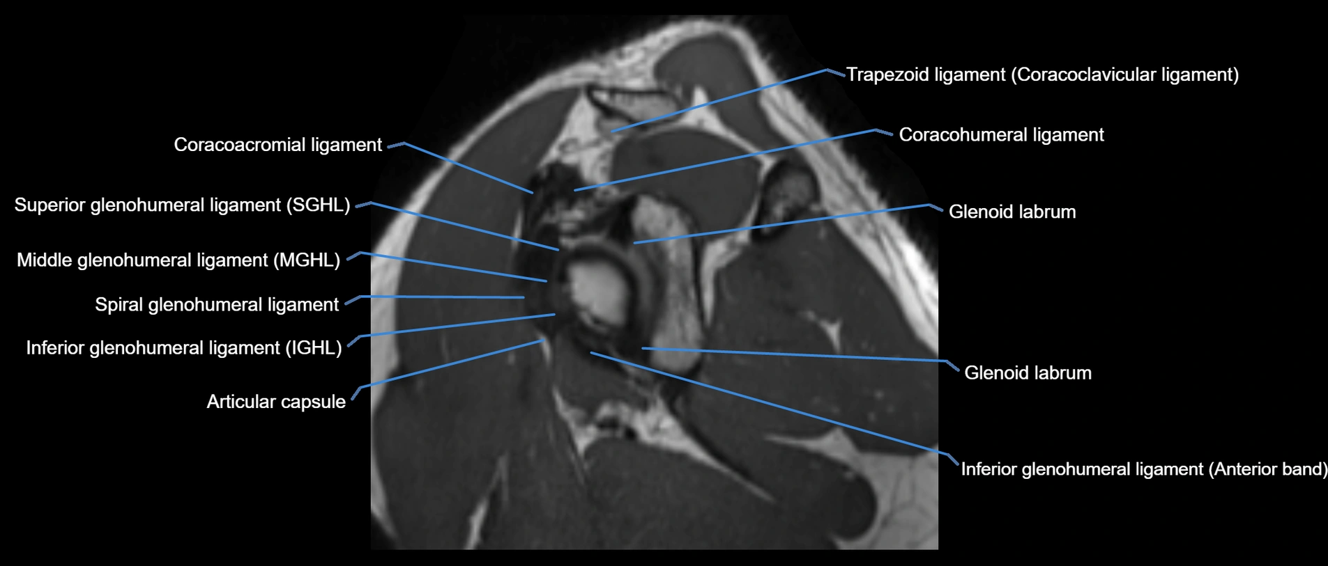 shoulder ligaments sagittal  cross sectional anatomy 3T MRI AI enhanced radiology image -img-00001-00026.webp